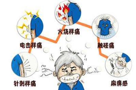 三叉神经痛