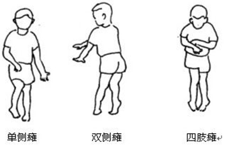 小儿脑瘫的危害