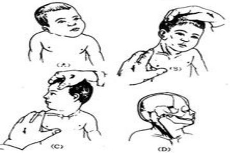痉挛性斜颈