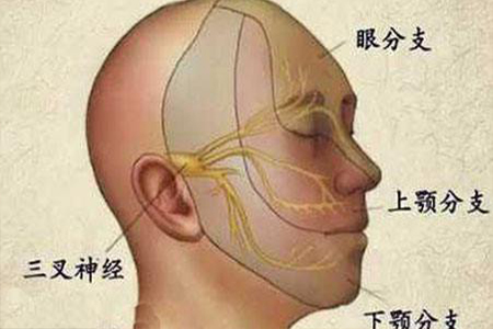 头部神经痛的治疗方法,微血管减压术是面肌痉挛患者的优选