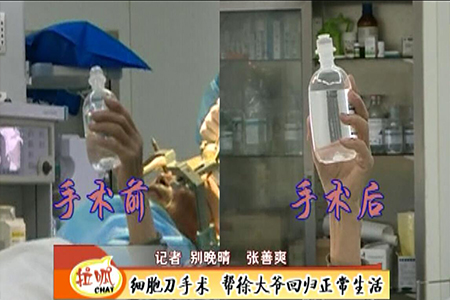 手抖8年有余 细胞刀止颤