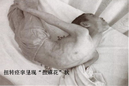 扭转痉挛是什么怪病?