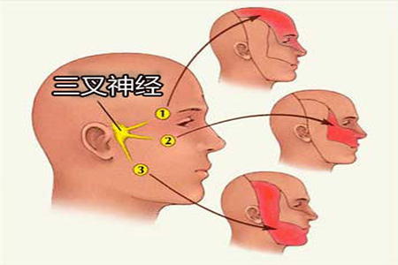 3年三叉神经痛折磨死去活来