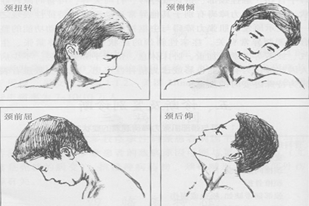 一分钟了解痉挛性斜颈